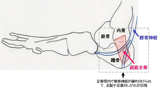 足 の 指 しびれ